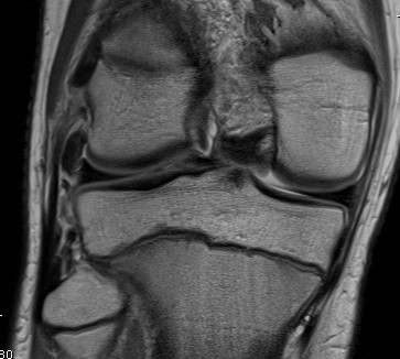 LCL MRI Normal Inferior Part